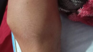 Photo of حوار مع شاب مصاب بالهيموفيليا .. رحلة معاناة لا تعترف بها القوانين