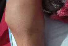 Photo of حوار مع شاب مصاب بالهيموفيليا .. رحلة معاناة لا تعترف بها القوانين